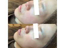 ピエル 北千住店(PIEL)/乳酸菌ピーリングで潤い肌へ