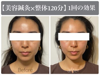 サンクエール 代官山鍼灸院(CINQ AILES)/美容鍼　むくみ・たるみ改善