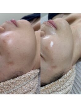 モアナ(Moana)/【業界初の光フォト広島専門店】