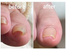 爪の状態に合わせた巻き爪補正［ネイル/フット/巻き爪/爪切り］
