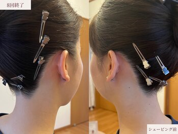 クラームビューティー(Clerm beauty)/美容師によるうなじデザイン脱毛