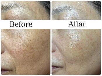 リラビューティー(Lilas Beauty)/プラチナムディープインジェット