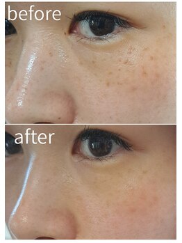 アースコアフュールボーテ ひたち野うしく店(EARTH coiffure beaute)/シミ◎ピンポイントで狙い打ち！