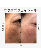 ツヤハダコガオ 千葉店/before⇒afteｒ　【プラズマ】