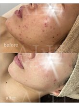アルフォービューティー 恵比寿店(ALU for beauty)/ニキビ症例