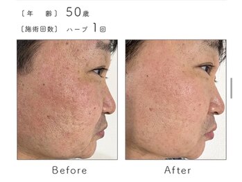 チップ(chip)/50歳/施術1回