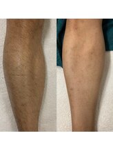 エアリアル 大川店/メンズボディ脱毛