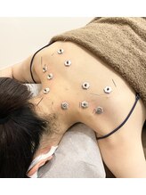 ウル鍼灸整骨院/首肩、鍼灸施術