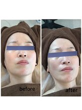 アジサイ(Ajisai)/リンパマッサージ＋フェイシャル