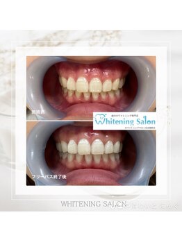 ホワイトニングサロン 名古屋駅店/【ホワイトニング施術例】