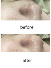 ティアム バイ テトテ 神戸三宮(TIAM by tetote)/毛穴洗浄＋ハーブピーリング