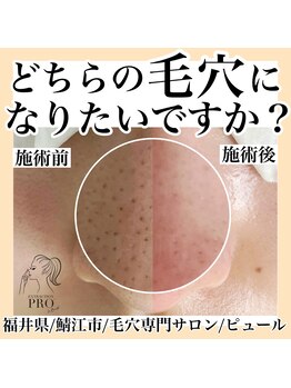 ピュール 鯖江店(PUR)/毛穴サロン/毛穴ケア/毛穴洗浄
