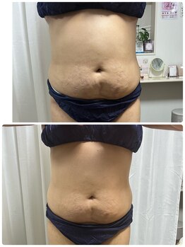 アスピリア(aspirer a')/上半身痩身！