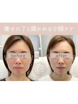 小顔になりたい