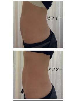 クルスカリダクション/ビフォーアフター 腹部・腰