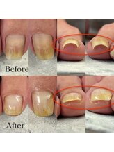 オーガニックネイルサロン プティ ボア(petit bois)/【巻き爪矯正】3回目