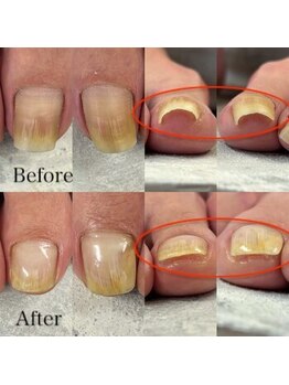 オーガニックネイルサロン プティ ボア(petit bois)/【巻き爪矯正】3回目