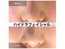 ビテキサロン ソワメーム(biteki salon SOI-MEME)の雰囲気（毛穴の奥まで美容液と吸引の力によって綺麗に洗い流します◎）