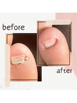 ボンド(The bond)/小指の副爪【ネイルケア 玉造】