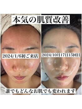 レイ(Rey)/悩み肌から韓国女優肌へ/肌改善