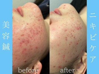 ビープラス(BEE PLUS)/ニキビケア