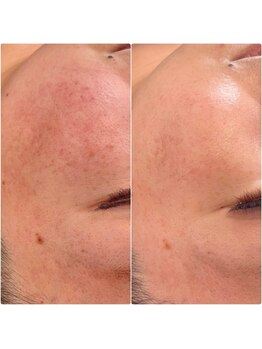 ジン フォー ユアビューティー(JIN for your beauty)/施術経過