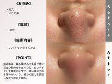 ルディラ 大宮店/ハイドラフェイシャル