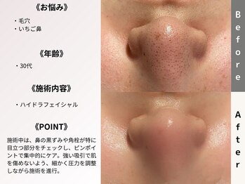 ルディラ 大宮店/ハイドラフェイシャル