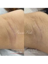 韓国肌管理yeoun【ヨウン】ROMAPINK/黒ずみ/毛穴/プラピール/ララピール福岡天神/ローマピンク福岡/メラニンケア