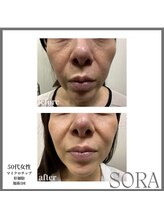 青空 天神大名店(SORA)/マイクロチップ×肝細胞 1回