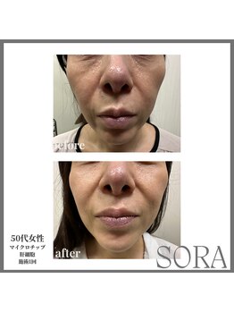 青空 天神大名店(SORA)/マイクロチップ×肝細胞 1回