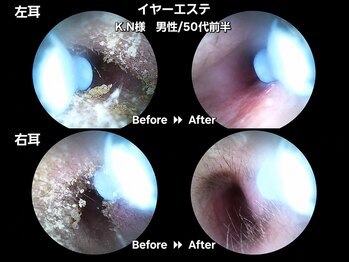 ツバキ 岐阜店(TSUBAKI)の写真/【岐阜希少】見て実感！イヤーエステで耳垢ケア＆耳つぼ♪極上ヘッドスパとのセットも◎/首肩こり/眼球疲労