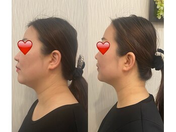 オプレア 千種店(OPREA)/【比較写真】7D