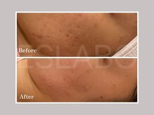 エスラボ オオサカ 心斎橋/剥離ありハーブピーリング