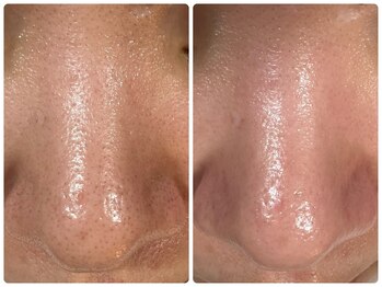 サイセイ(SAISEI)/皮脂もゴッソリ取ります!