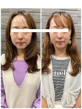 長寿鍼灸院 長寿整骨院/左右非対称のお顔に美容鍼★50本