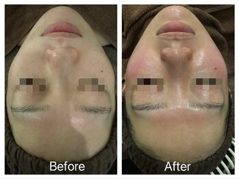 アトリエール(Ateliere)/REVI×ハイドラフェイシャル