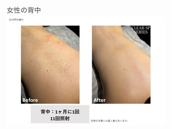 リネ(Rine)/before→after