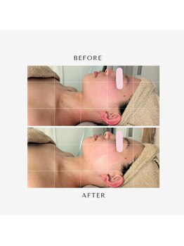 フィル 名駅店(fil)/【リピートNo.1】fil 小顔コルギ