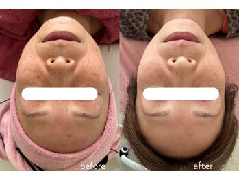 ナンバーナイン(No.9)/結果にこだわるシミケア