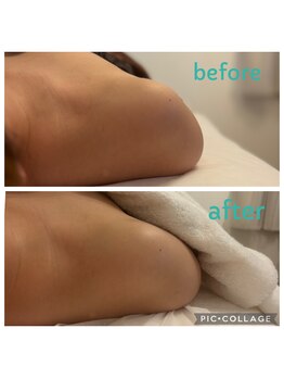 ナチューラ(Natura)/一度の施術で巻き肩改善　その１