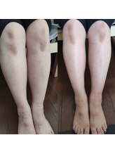 インディバサイタマックス(INDIBA SAITAMAX)/浮腫み