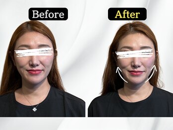 ハリユナイテッド 原宿鍼灸 整体院(HALI UNITED)/美容鍼+小顔矯正でむくみ改善