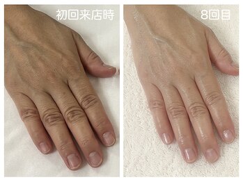 キレイテ 福岡天神店/くすみと血管浮き