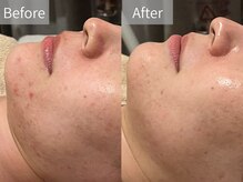 シェリーミル(Cherie Miru)/繰り返す顔周りニキビ/赤ニキビ