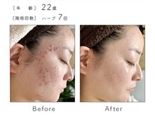 チップ(chip)/22歳／施術7回
