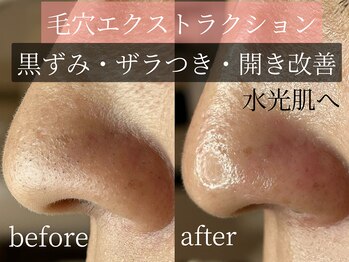 メゾン ミニョンヌ(maison mignonne)/毛穴施術写真