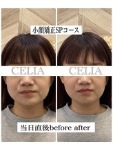 セリア(CELIA)/小顔/小顔矯正/面長/エラ張り