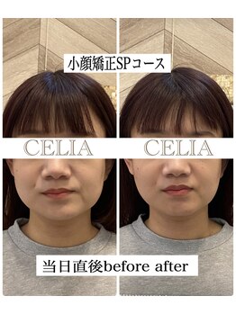 セリア(CELIA)/小顔/小顔矯正/面長/エラ張り