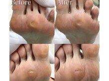 巻き爪補正店 札幌店/ 【【硬いタコ/魚の目ケア】